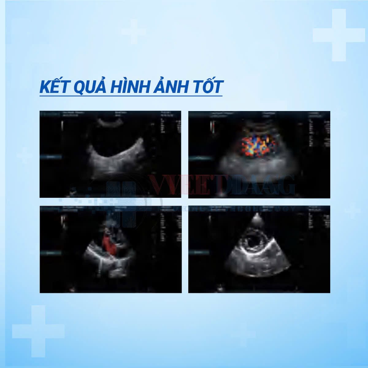 Hình ảnh siêu âm tim và Doppler màu trên Revo T2 Vet